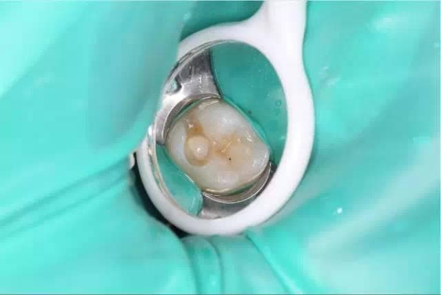 临床橡皮障使用图文操作
