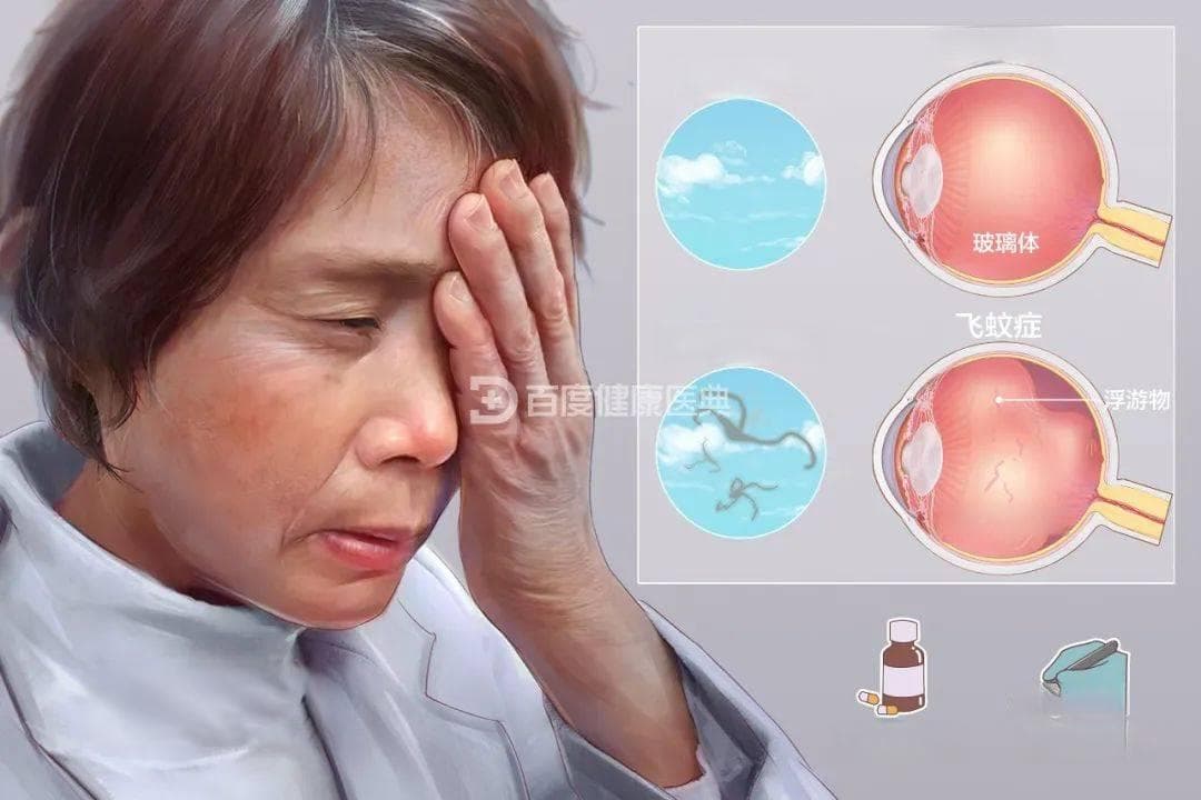 “黑影浮动”之困 —— 解读飞蚊症