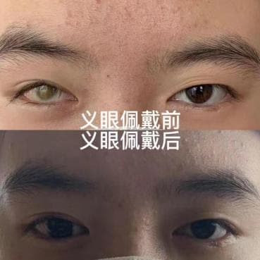 以假乱真的义眼