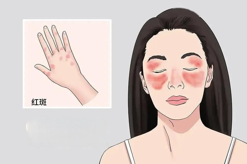 【健康科普】了解红斑狼疮