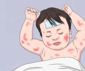 川崎病的孩子能活多久