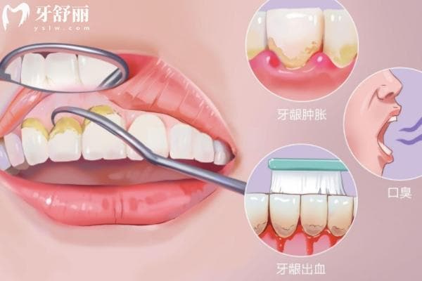 超声波洗牙和喷砂洗牙区别？适合人群与价格对比