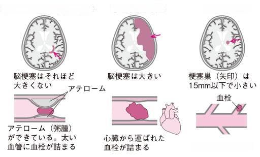 腔梗与脑梗：从症状到治疗的五大区别