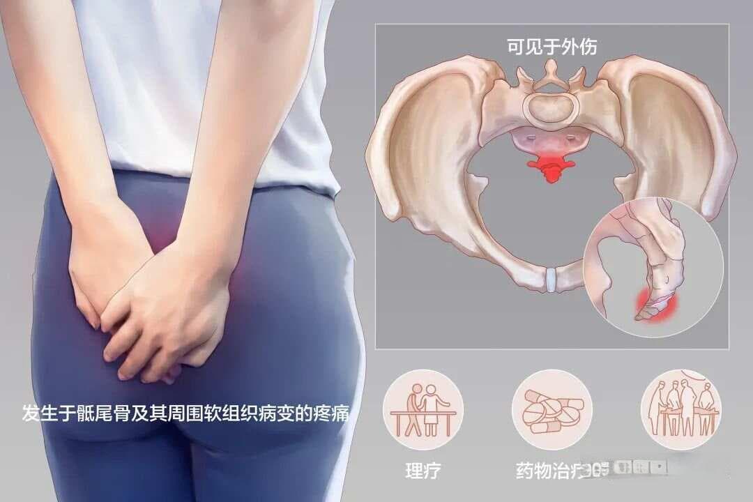 尾骨痛的相关解剖、病因及诊疗分析