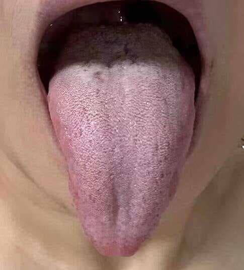 肝郁的人，这三种舌象必占一个！