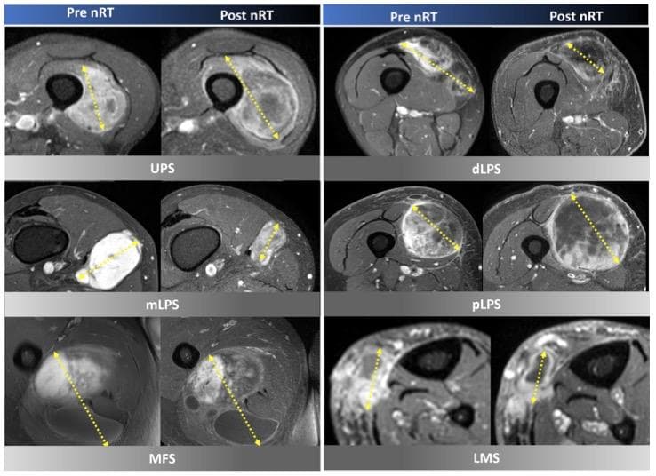 European Radiology：软组织肉瘤组织类型对新辅助放疗反应的异质性