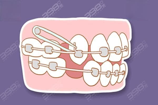 牙齿代偿性正畸是什么意思？掩饰性正畸和代偿性正畸区别在何处？