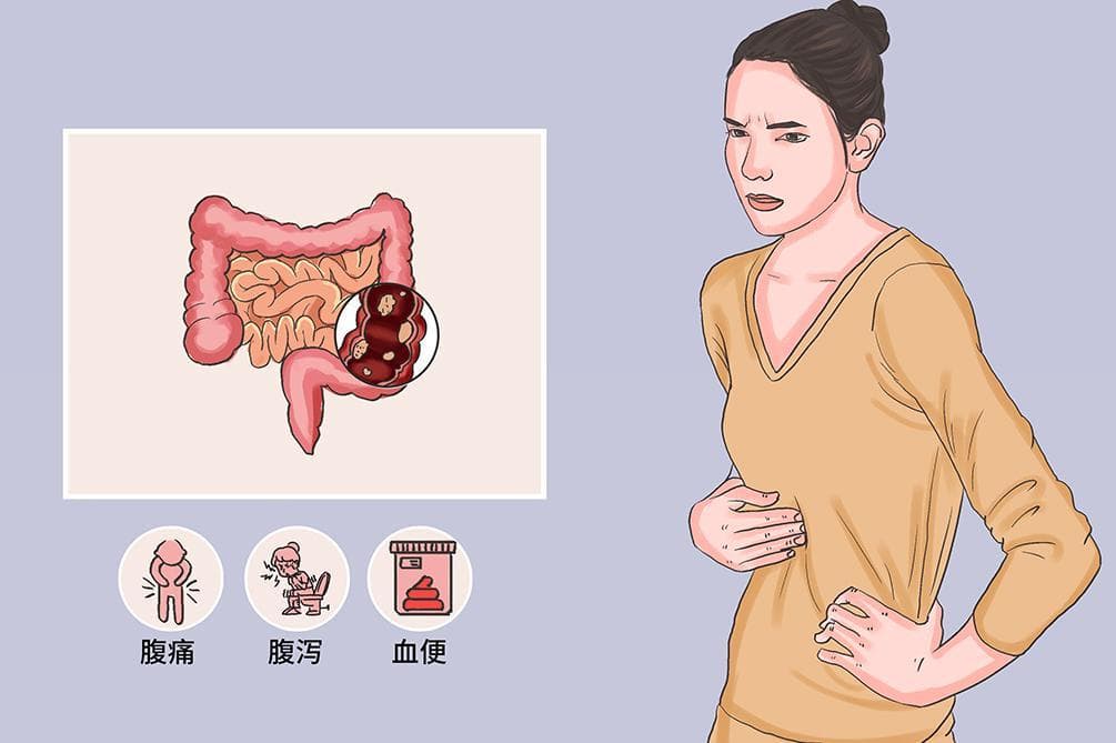 腺瘤性息肉：症状、诊断与治疗全解析