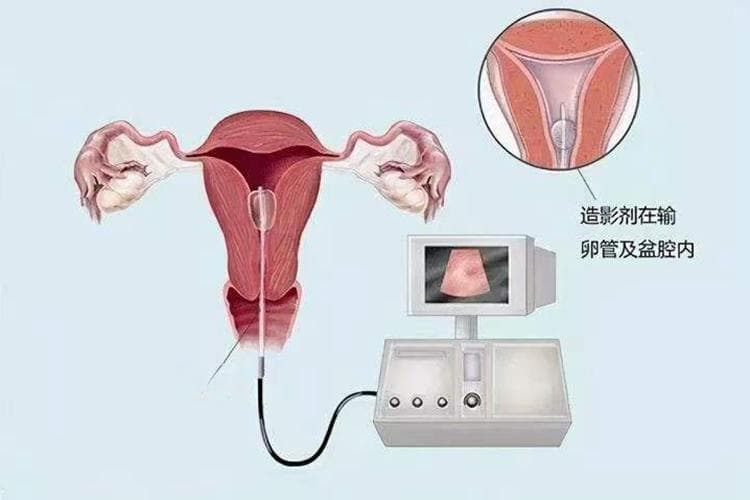 造影剂对身体有什么副作用