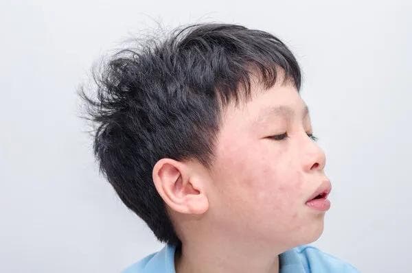 吃荞面为什么会过敏？五种可能原因及应对方法