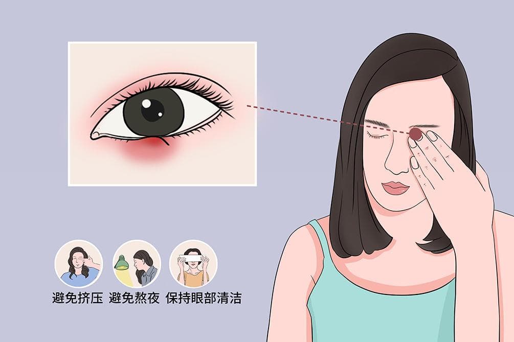 麦粒肿是怎么回事