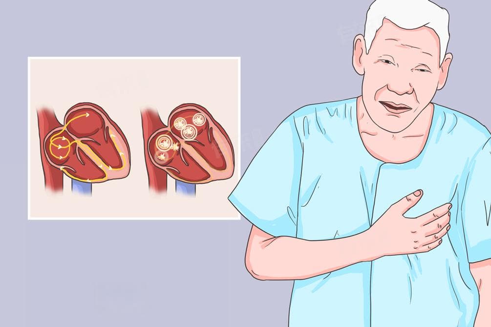 感觉心房颤动是怎么回事
