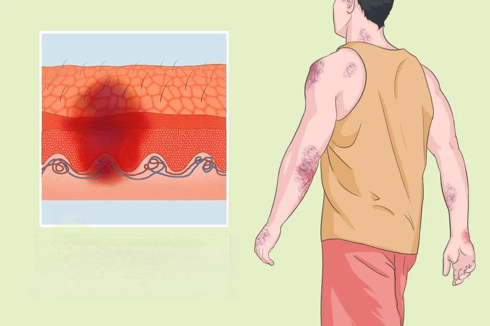 瘀斑：症状、病因、诊断与治疗全解析