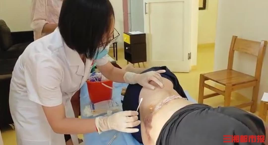 厉害了！援非中医用“棉花”治疗带状疱疹