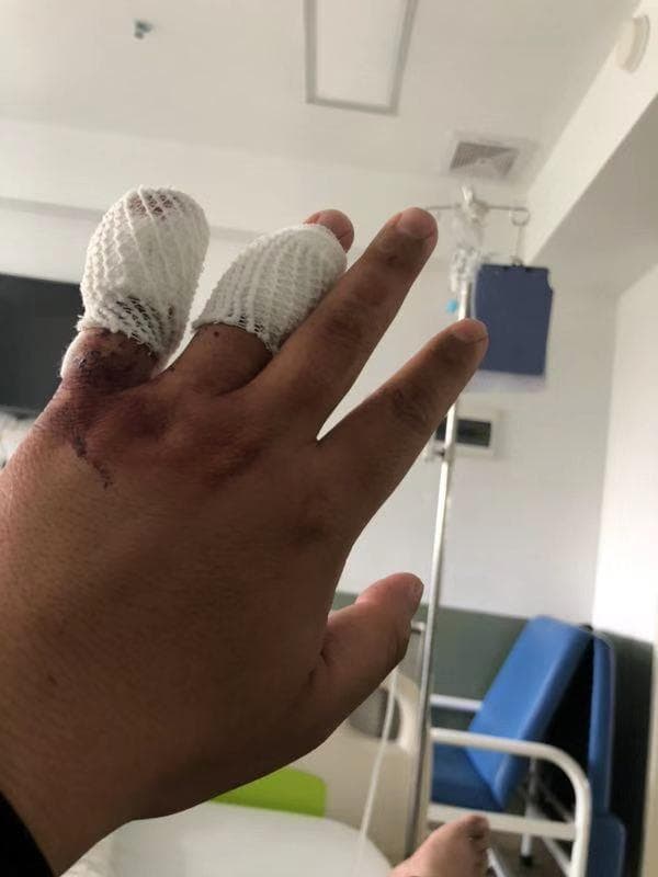 手指骨折两个月能否康复的探讨