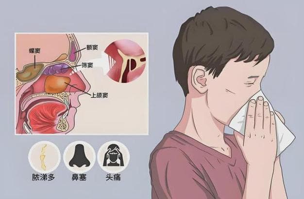 鼻涕是哪个脏腑产生的?