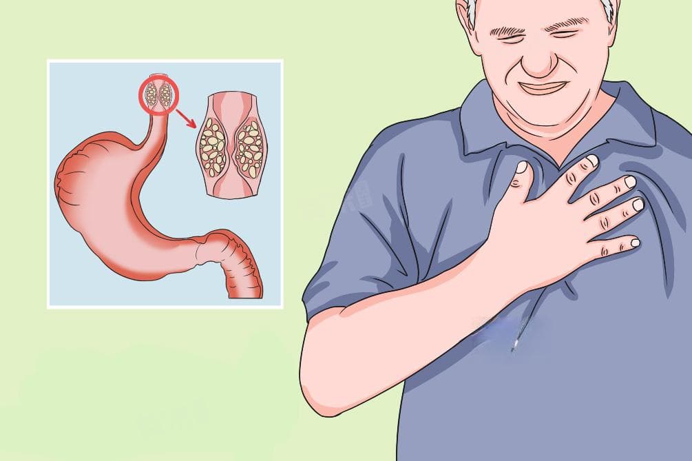 食管癌怎么治疗效果最好？