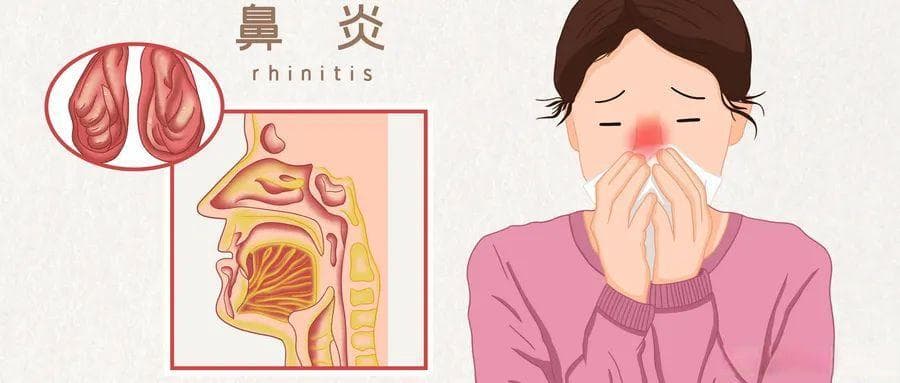 过敏性鼻炎用药指南：氯雷他定片的适应症与副作用分析