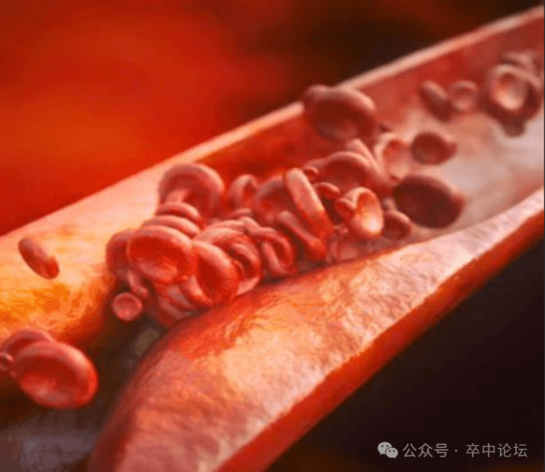 JAMA：大梗死核心脑卒中取栓的缺血损伤及半暗带特征