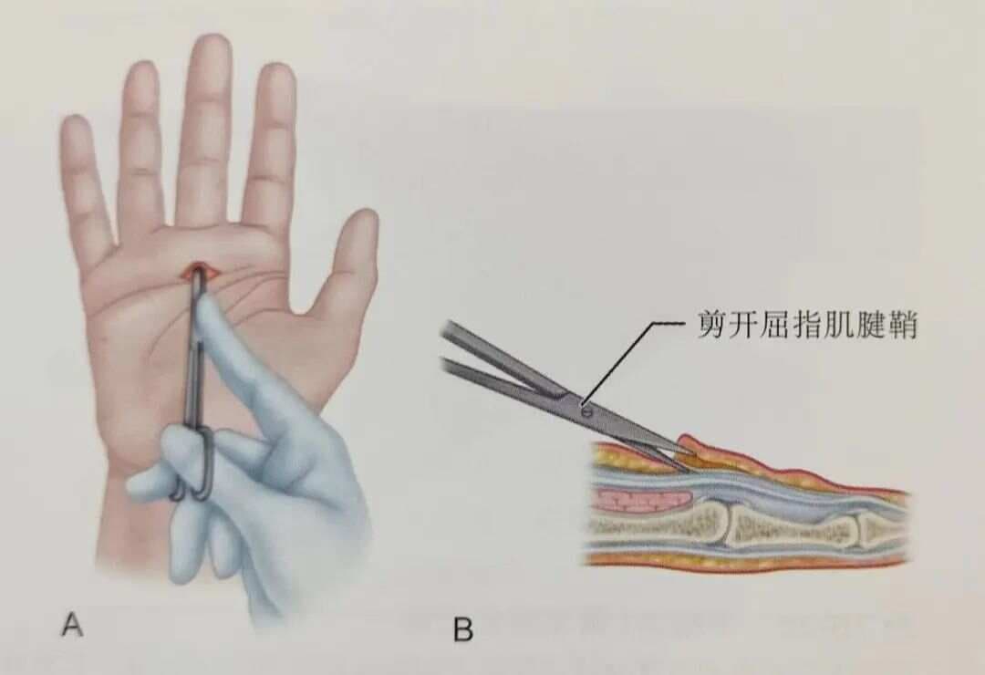 常见的两种狭窄性腱鞘炎的手术疗法，超详细！