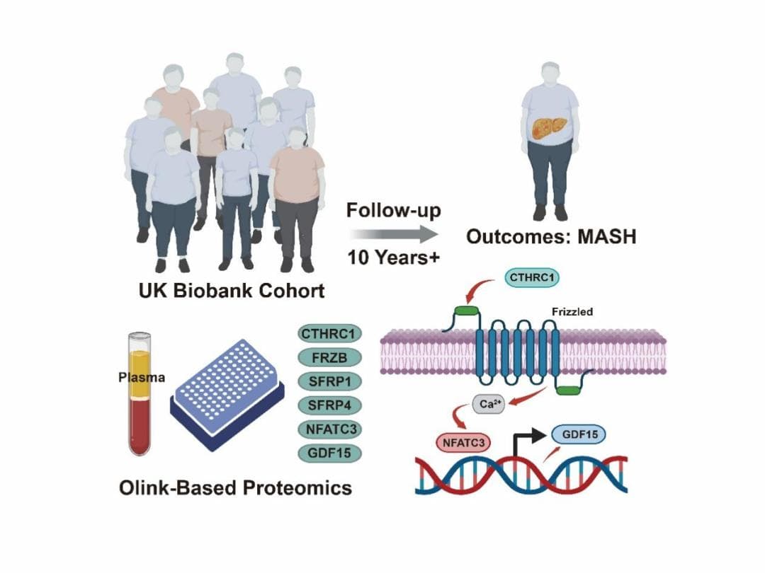 Hepatol Int：GDF15对MASH的发病具有良好的预测能力