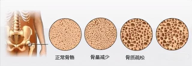 务必重视！40岁前就要防骨质疏松！这些妙招学起来！