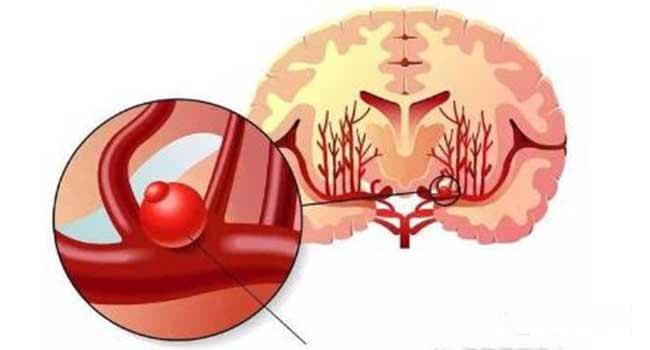 脑动脉瘤的5种常见治疗方法及手术风险