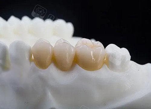 牙齿缺失又不想种牙怎么办？其实缺牙除了种植牙还有固定义齿、活动义齿修复