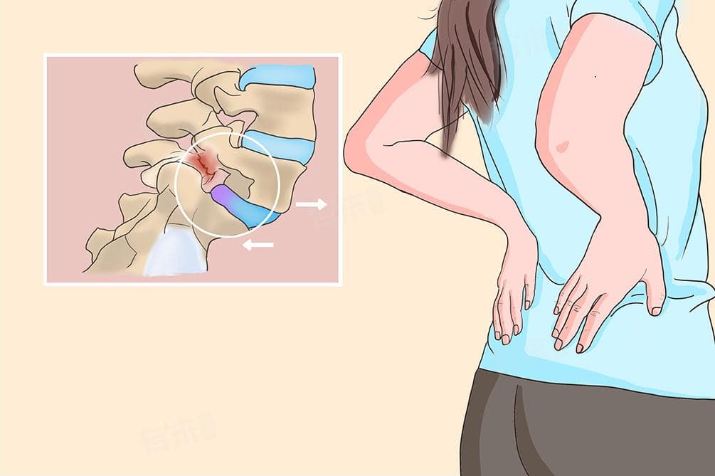腰椎滑脱三大禁忌