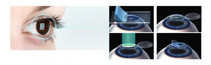 LASIK 是一种永久性治疗视力异常（近视、远视、散光）的手术方法。