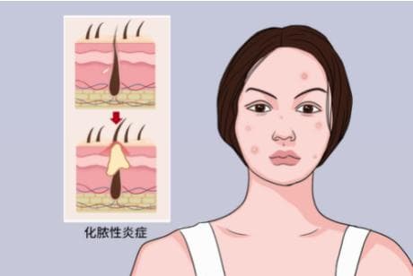 毛囊炎反复发作怎么办？做好4点可预防！