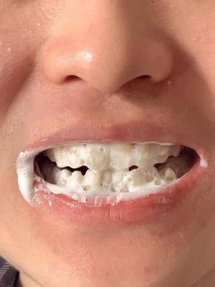 牙医亲授：如何正确预防和去除牙结石