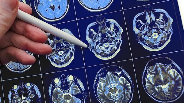 脑白质脱髓鞘病变：病因、症状与治疗全解析