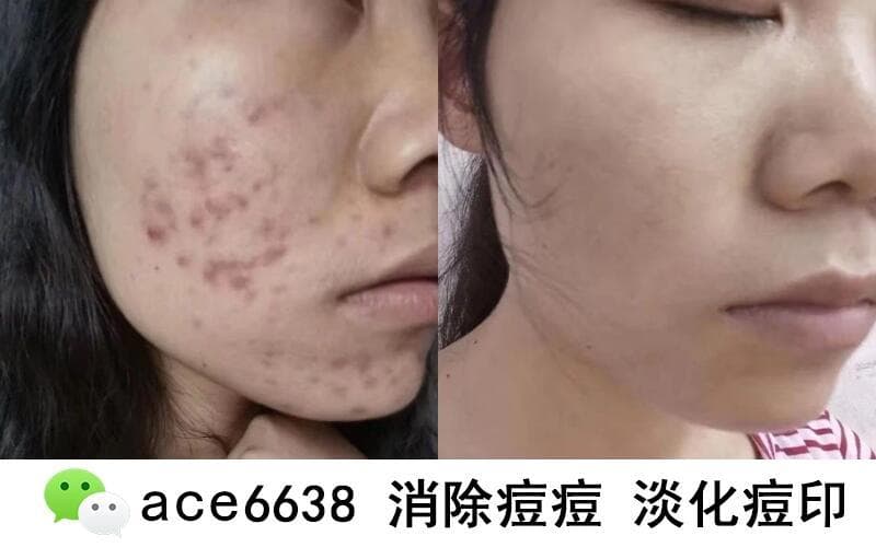熬夜容易长痘痘吗 如何养成无痘肌肤