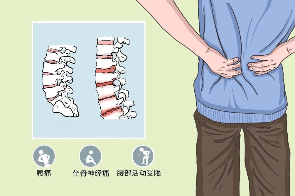 对腰椎病最好的运动