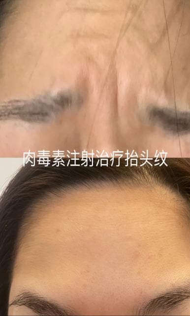 肉毒素：美丽与健康的科学选择