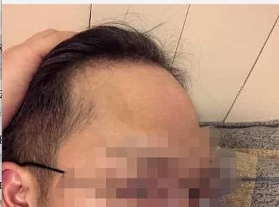 米诺地尔酊治疗哪些人群的脱发？看看你符合哪种？
