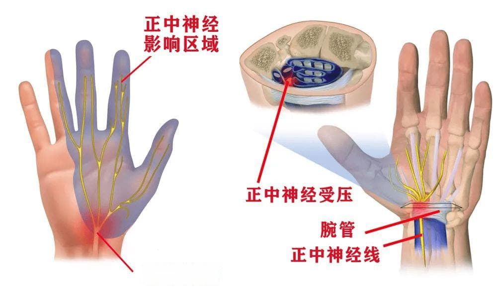 手腕肿胀、疼痛？腕管综合症的处理方法有哪些？