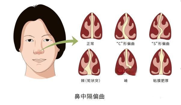 有人说鼻中隔偏曲不需要做手术？听听专家怎么说