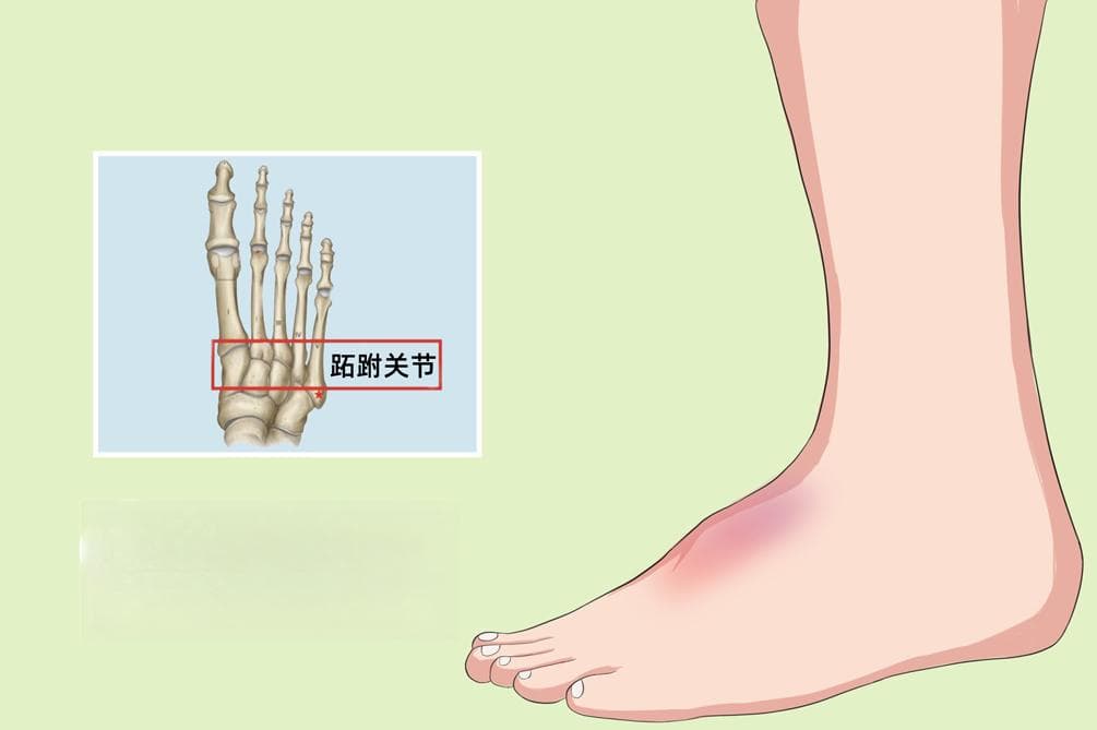 Lisfranc损伤：从病因到治疗的全面解析