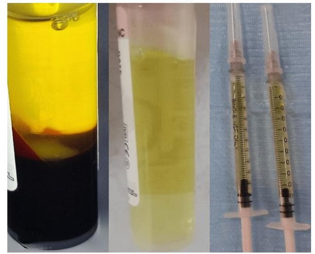 Cureus：富血小板血浆注射对正畸牙齿加速移动过程中牙周健康的影响