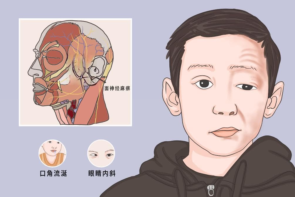 面肌痉挛属于哪个科室