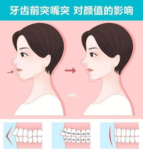 告别龅牙，拥有迷人笑容的小妙招