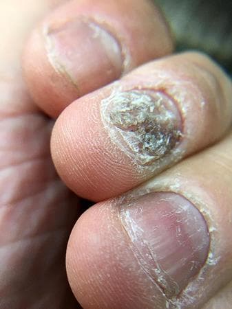 银屑病甲损与灰指甲的区别：从发病机制到临床表现的全面解析