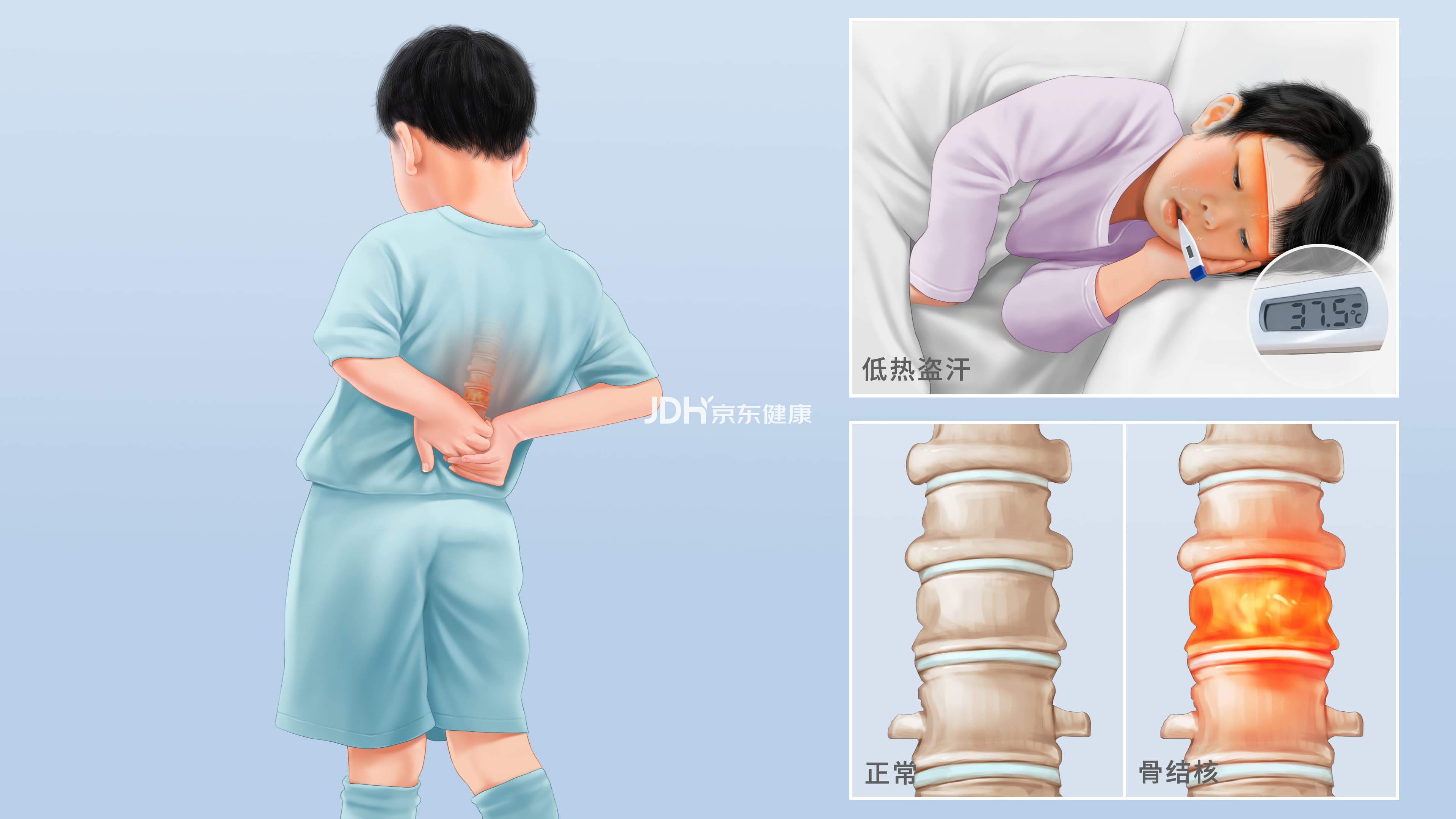 骨结核：症状、诊断与预防全解析