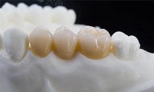 详细解析牙冠佩戴全过程：从准备到佩戴的每个步骤及注意事项