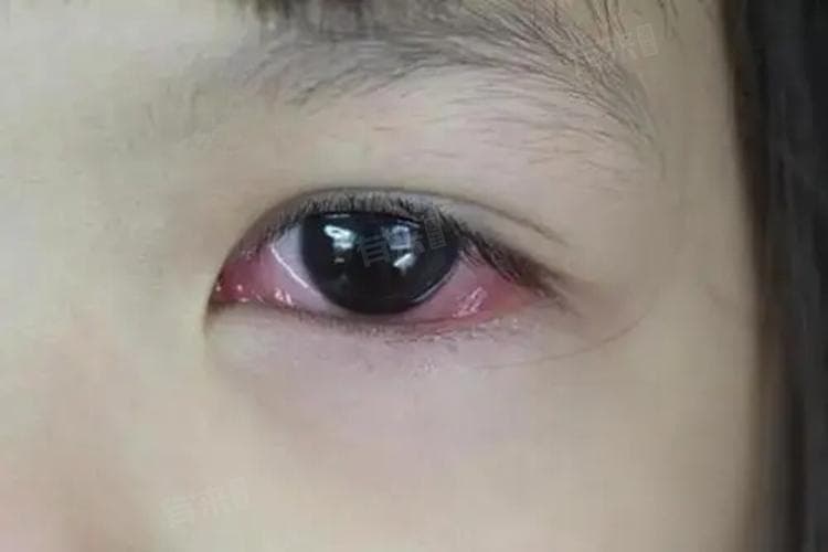 眼睛流泪的治疗方法