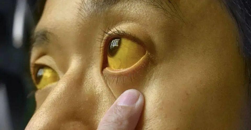 乙肝患者需警惕，四个变化暗示肝硬化！