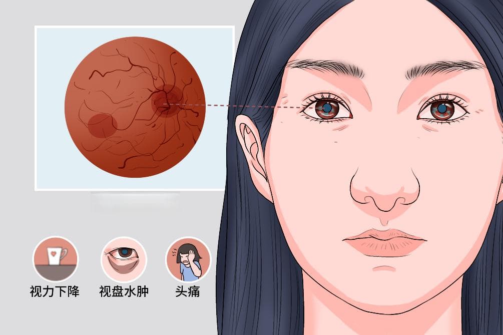 缺血性视神经病变