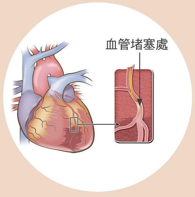 胸闷是心脏问题吗？一文读懂胸闷胸痛的原因与应对方法